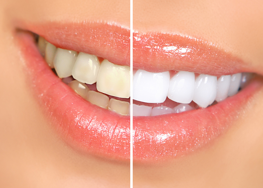 cosmetic dentistry teeth whitening clifton ny